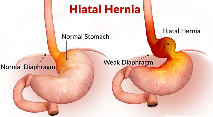 hiatal hernia treatment in india
