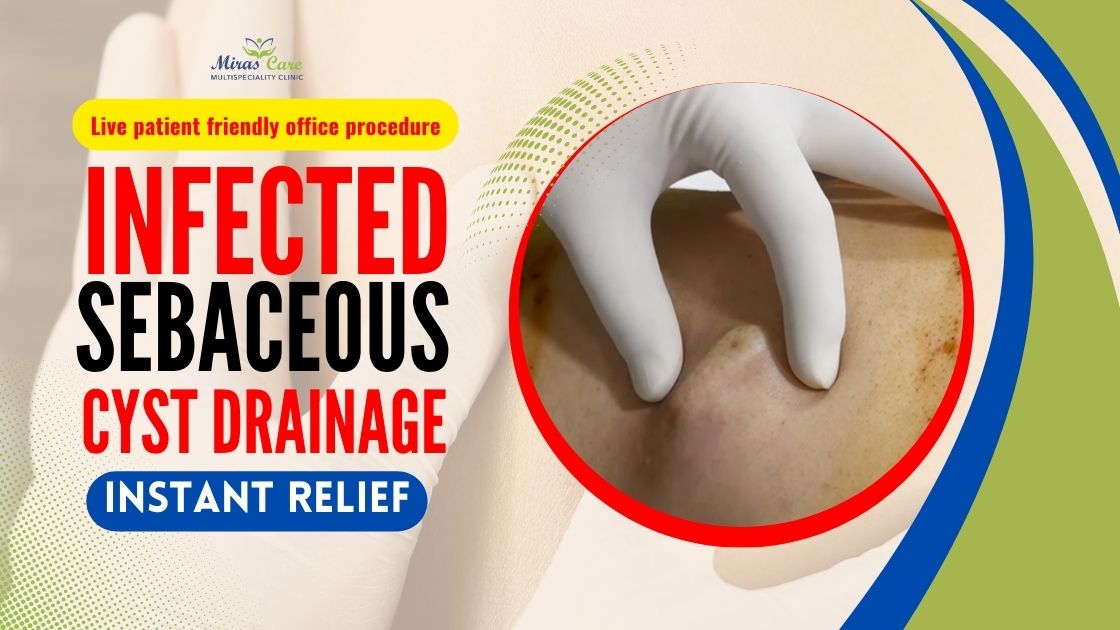 Infected sebaceous cyst