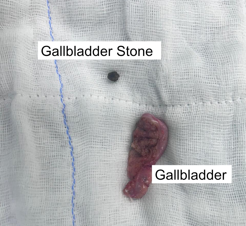 Gallstone Treatment in Delhi NCR
