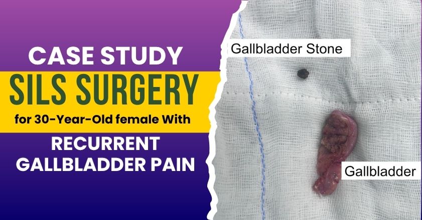 Single Incision Laparoscopic Cholecystectomy (SILS)