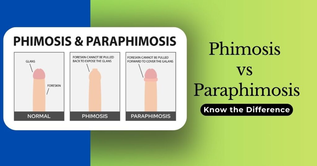Phimosis vs Paraphimosis: Know the Difference