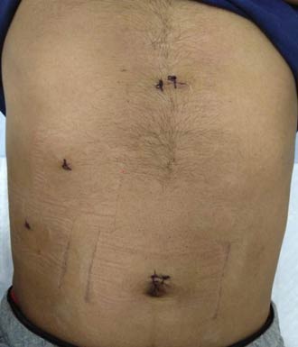 4/3 Port laparoscopic Gallbladder stone surgery in India