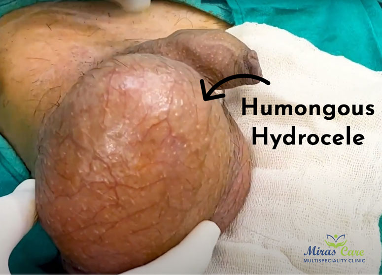 What is Humongous-Hydrocele?