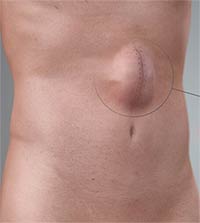 What is an Incisional hernia