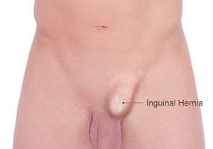 What is Inguinal Hernia?