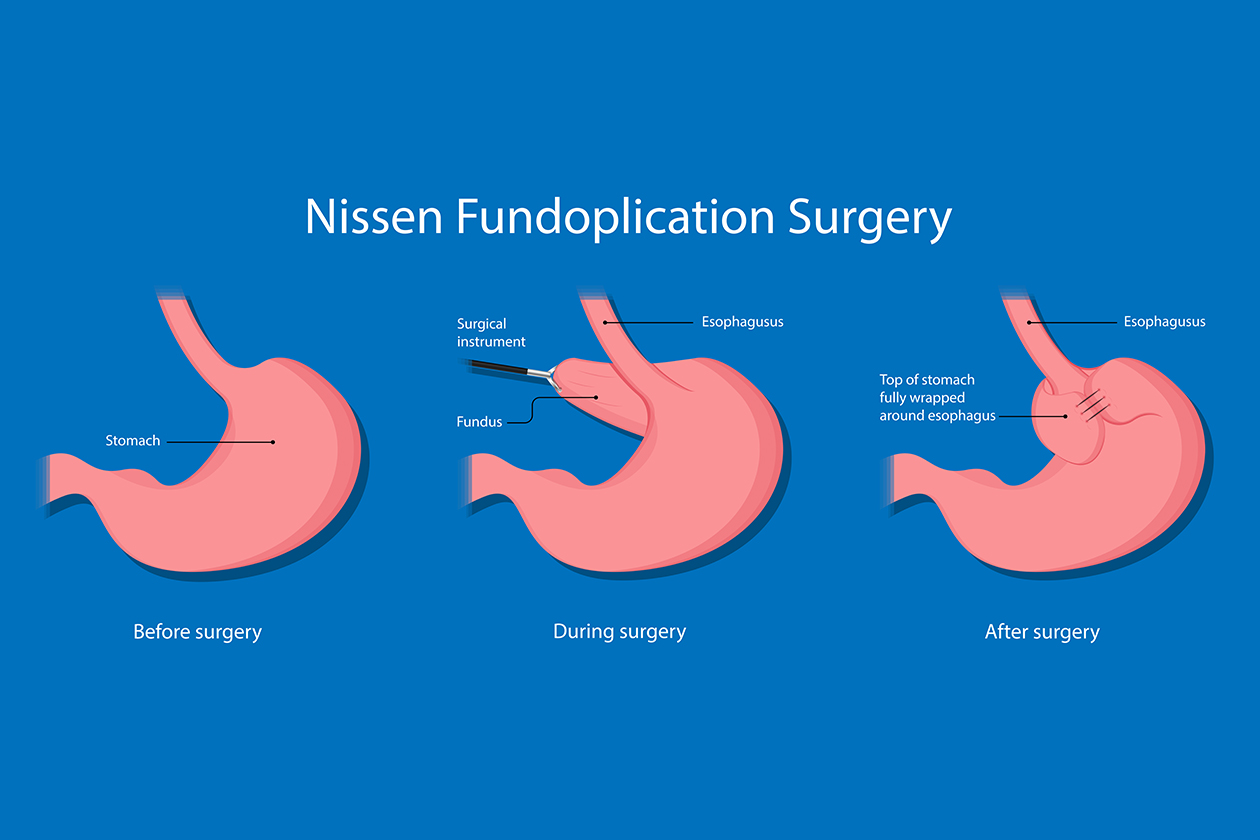 Fundoplication Treatment in India