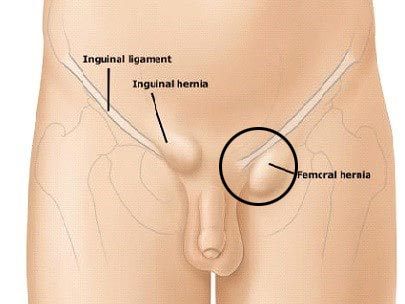 What is Femoral Hernia?