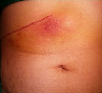 Open Surgery (Cholecystectomy) Open Surgery (Cholecystectomy)