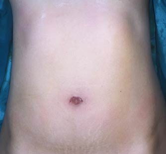 Single Incision laparoscopic cholecystectomy in India