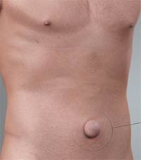 What is an umbilical hernia?